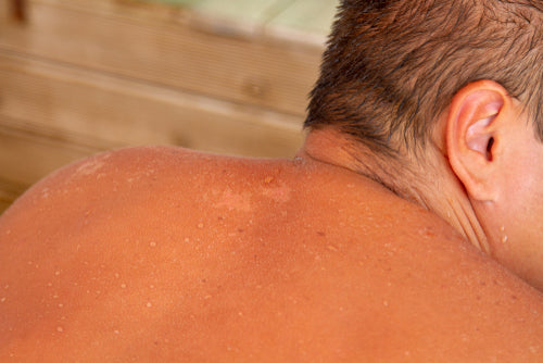 man with sunburned skin man with sunburned skin